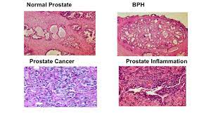 Prostatitis — or inflammation of the prostate — is the second most common cause of an enlarged prostate following bph, and almost always occurs as a result of an infection. Prostate Inflammation And Prostate Cancer What Do I Need To Know