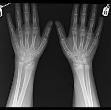 Image result for Hand Growth Plates