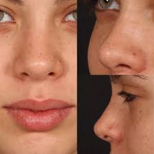 The Nose Of Each Man Is Different The Starting Point Is Very Important Such Nuts Before And After Nose Reshaping Nose Plastic Surgery Rhinoplasty Nose Jobs