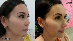 Asia Clinic Cosmetic Plastic Surgery Bangkok Thailand The Best Nose Augmentation In Thailand