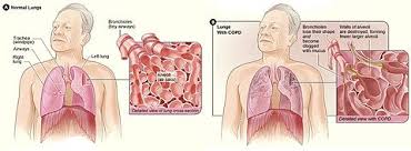 Symptoms include coughing up sputum, wheezing, shortness of breath, and chest pain. Chronic Obstructive Pulmonary Disease Wikipedia