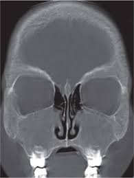 It constitutes the upper respiratory system along with the paranasal sinuses , oral cavity, pharynx and larynx, and. Nasal Cavity Paranasal Sinuses Radiology Key