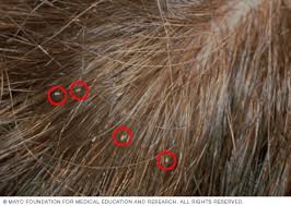 Maybe you would like to learn more about one of these? Lice Symptoms And Causes Mayo Clinic