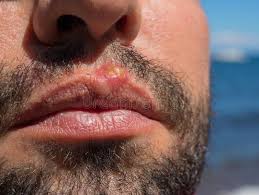 Herpes Auf Der Nase Junge Frau Mit Herpes Auf Ihrer Nase Stockfoto Bild Von Grob Schmerzlich 65728952