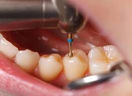 Cavity Filling The Procedure Aftercare And Long Lasting Preferred Dental