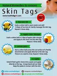 How To Remove Skin Tags Yourself Naturally Skin Tag Removal Skin Tag Oils For Skin