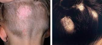 القوباء الحلقية في الشخص trichophytosis صور