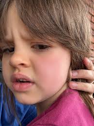 Are headaches a sympton