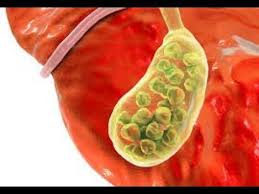 Reverse Fatty Liver Dissolve Gallstones Naturally Gallbladder Cleanse Gallstones Gallbladder