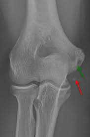 Tommy john surgery is a procedure that reconstructs a torn ulnar collateral ligament. Tommy John Surgery Ucl Injury Overview Dr Christopher Ahmad