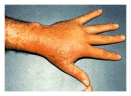 Image result for Photodermatitis