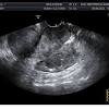 Such cases of bilateral pelvic kidneys can cause serious difficulty in normal delivery/ childbirth. 3