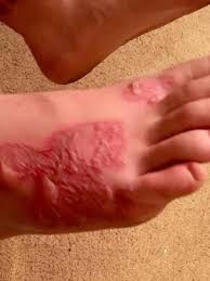 Cacing jenis ini biasanya memasuki badan melalui kulit atau mulut dan sebaik masuk ke dalam badan, ia boleh bergerak ke organ lain termasuk mata. Timbun Tubuh Di Pasir Pantai Cacing Tambang Bersarang Di Kaki Health Liputan6 Com