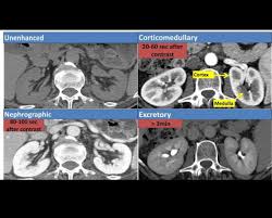 Image result for Helical CT Urogram