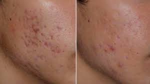 It contains vitamin e that can help increase blood flow to scar tissues.it also contains rosehip seed oil, sunflower oil and shea butter. Laser Treatment For Acne Scars What To Expect Cost And More