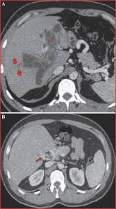 John Libbey Eurotext Sang Thrombose Vaisseaux Hydatidose Hepatique Compliquee D Un Cavernome Porte Par Essaimage Veineux Portal A Propos D Un Cas