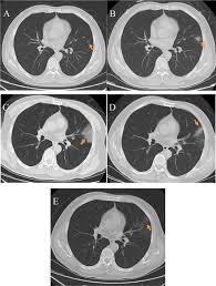 Ct imaging of rapid progression stage. Preliminary Ct Findings Of Coronavirus Disease 2019 Covid 19 Clinical Imaging