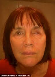 June Scott had her left eye removed after developing a fungal infection from wearing contact lenses. Medics in Spain - where she lives during the winter ... - article-2276936-17818BC1000005DC-929_306x423