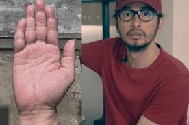Albums et chansons en streaming et téléchargement mp3. Rico Blanco Undergoes Surgery Reveals He Has Carpal Tunnel For Over 20 Years Showbiz Chika