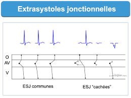 Image result for Extrasystole