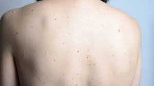 Les grains de beauté sont une accumulation de cellules pigmentées qui apparaissent comme des points bruns ou noirs sur la peau. Enlever Un Grain De Beaute Naturellement Minutefacile Com