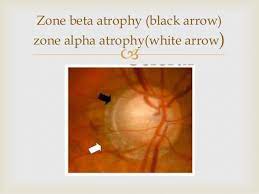 Pin On Eye Diseases