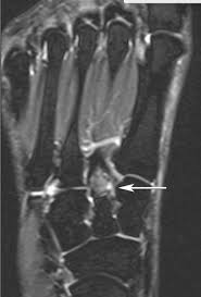 The muscles acting on the foot can be divided into two distinct groups; Aspetar Sports Medicine Journal Mri Of Ankle And Foot Injuries In Ballet Dancers