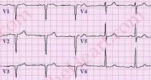 Image result for icd 10 code for anterior mi