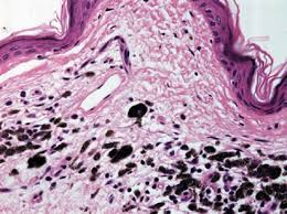 Working in a histology lab means that i get to see a lot of what our body looks like under the microscope. Histologic Criteria For Diagnosing Primary Cutaneous Malignant Melanoma Modern Pathology