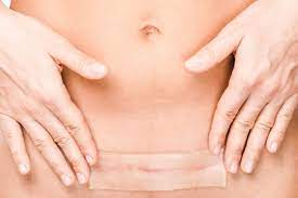 The Untapped Strategy You Need To Stop Your C Section Scar From Itching Today She Births Bravely