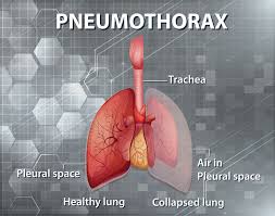 Normally, the outer surface of the lung sits next to the inner surface of . Pneumothorax Diagnosis And Management In The Ed Pedmore Medical