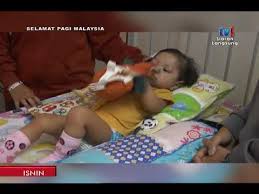 Maka aisyah telah menjalani pembedahan jantung sebanyak 2 kali di ijn untuk asd, vsd dan pa banding.total berjaya tutup 4 lubang. Spm 2018 Bingkisan Kos Rawatan Pesakit Jantung Di Ijn 29 Jan 2018 Youtube