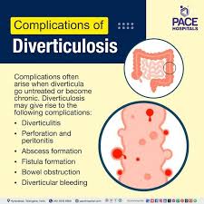 Image result for Diverticular Bleeding