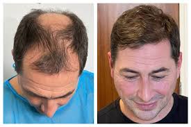 Dr. Ted Miln Norwood 5 3,227 Grafts FUE