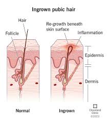 Image result for sore skin in the groin area