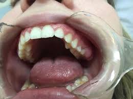 Bleeding may occur, as well as pain.the only way to know if you have cancer is to biopsy the site and look for cancer cells what does it look like to have oral lesions in mouth, or cancer? Pathogens In The Mouth Induce Oral Cancer Eurekalert Science News