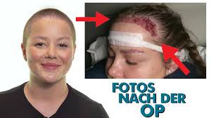 Wird die behandlung beendet, können die haare wieder ausfallen. Haartransplantation Frauen Grunde Und Moglichkeiten Haarausfall Hilfe