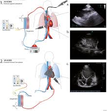 Ecmo — venös arterielle ecmo schema beim neugeborenen die extrakorporale membranoxygenierung (ecmo) ist eine form der extrakorporalen organersatzverfahren, auch extracorporeal life support= extrakorporale lebensunterstützung (ecls) genannt, und… … Echocardiography For Adult Patients Supported With Extracorporeal Membrane Oxygenation Critical Care Full Text