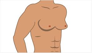 Many males with breast cancer have inherited a brca mutation, but there are other causes, including alcohol use disorder and exposure to certain hormones and ionizing radiation. Gynecomastia Causes
