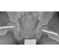 Sistema de tornillos Free-Gliding SCFE™ - OrthoPediatrics