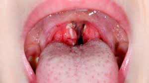 Mandelentzündung erkennen und behandeln | Apotheken Umschau