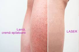 Eritem is an information communication technologies (ict) company established to provide total integrated ict services. Senzofit Galerie Imagini Epilare Definitiva Cu Laser