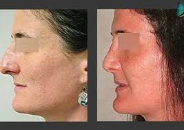 Rhinoplasty Beverly Hills