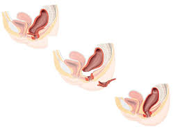 Nach der prozedur sollen sich die zugeführten darmbakterien im darm des patienten verbreiten und diesen besiedeln. End Und Dickdarm Zentrum Essen Verstopfung Stuhlentleerungsstorung