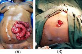 How long did you suffer with pain or nerve issues? Abdominal Stab Wound In A Pregnant Woman Resulting In Evisceration Uterine Perforation And Fetal Chest Injury A Case Report And Literature Review