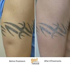 Tattoo advanced specialized treatment options | picosure laser tattoo removal. Client Has Opted For Full Removal Of Their 20 Year Old Tribal Arm Cuff And It S Going Fairly Smoothly So Far After 2 Trea Tattoo Removal Tattoos Tattoo Eraser