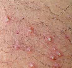 Image result for folliculitis symptoms