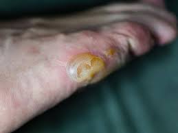 Image result for Eczema nummulare