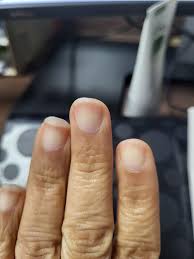 Hi, I am worried sick. Please advise if these are terry nails. I ...