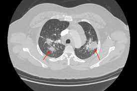 It level plodovnica po kapljicah sunday funday ex 2012 tarik phillips wvu scottish wool, per fisher. Cureus A Rare Case Study About Necrotizing Granulomatous Sarcoidosis
